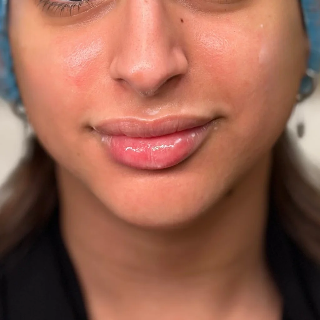 حالة 2 فيلر شفايف في عيادة لوسرا