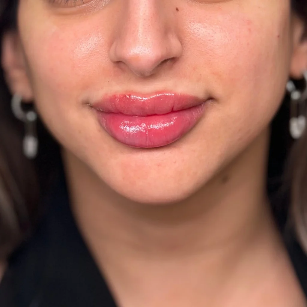 حالة 2 فيلر شفايف في عيادة لوسيرا