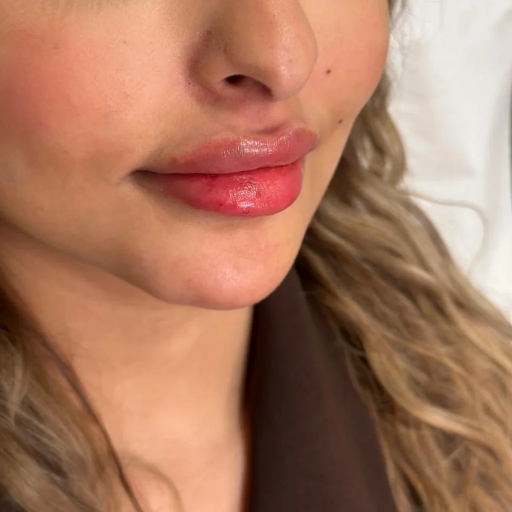 حالة فيلر شفايف في عيادة لوسيرا