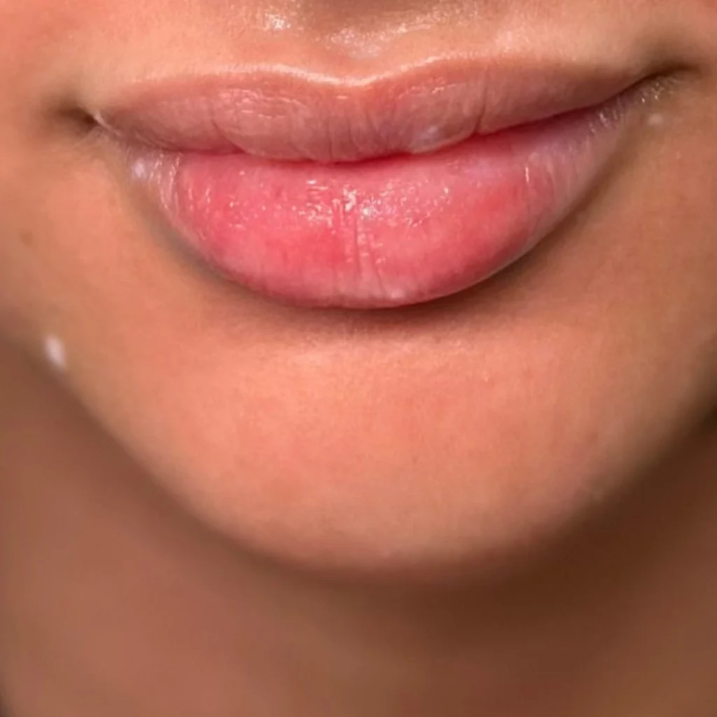 حالة 3 فيلر شفايف في عيادة لوسيرا قبل