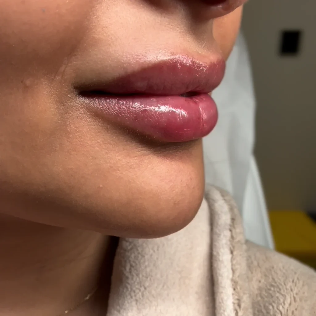 حالة 4 فيلر شفايف في عيادة لوسيرا بعد