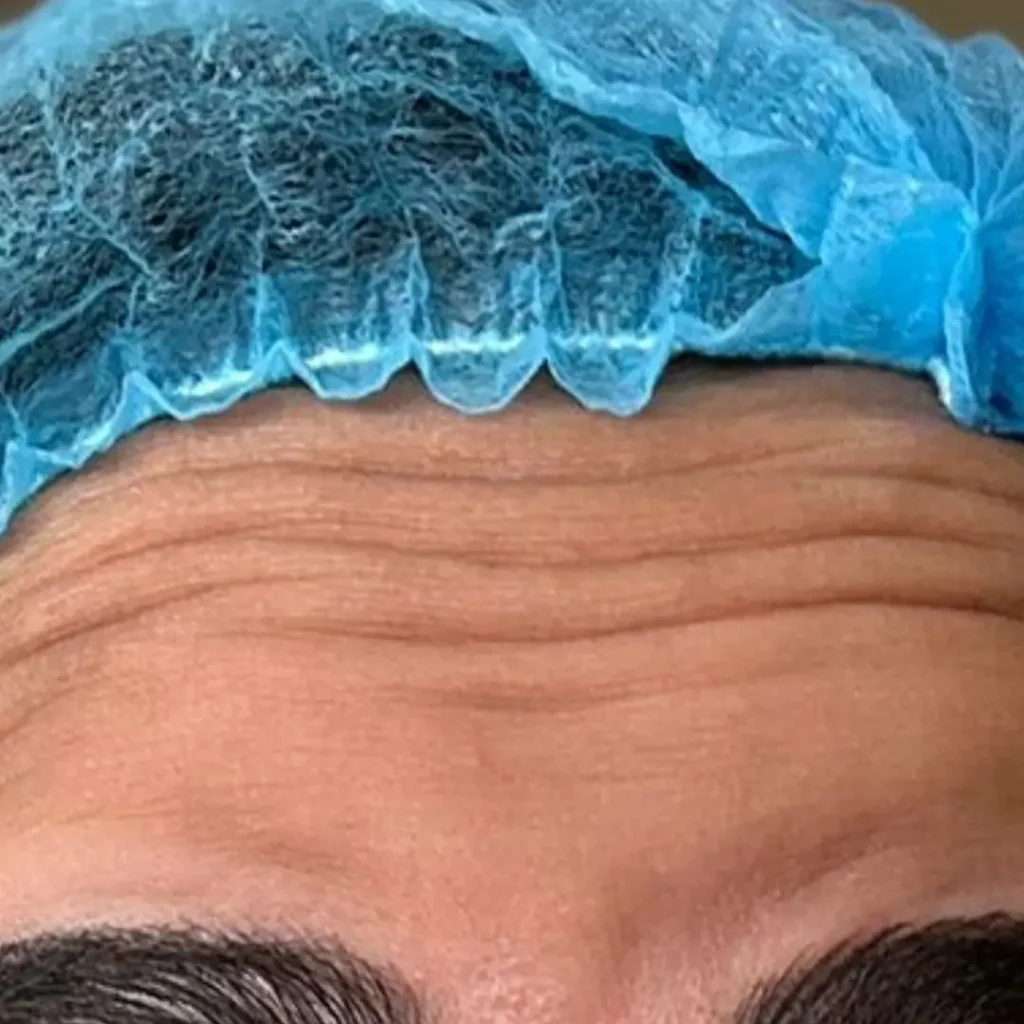 حالة 1 بوتكس في لوسيرا قبل