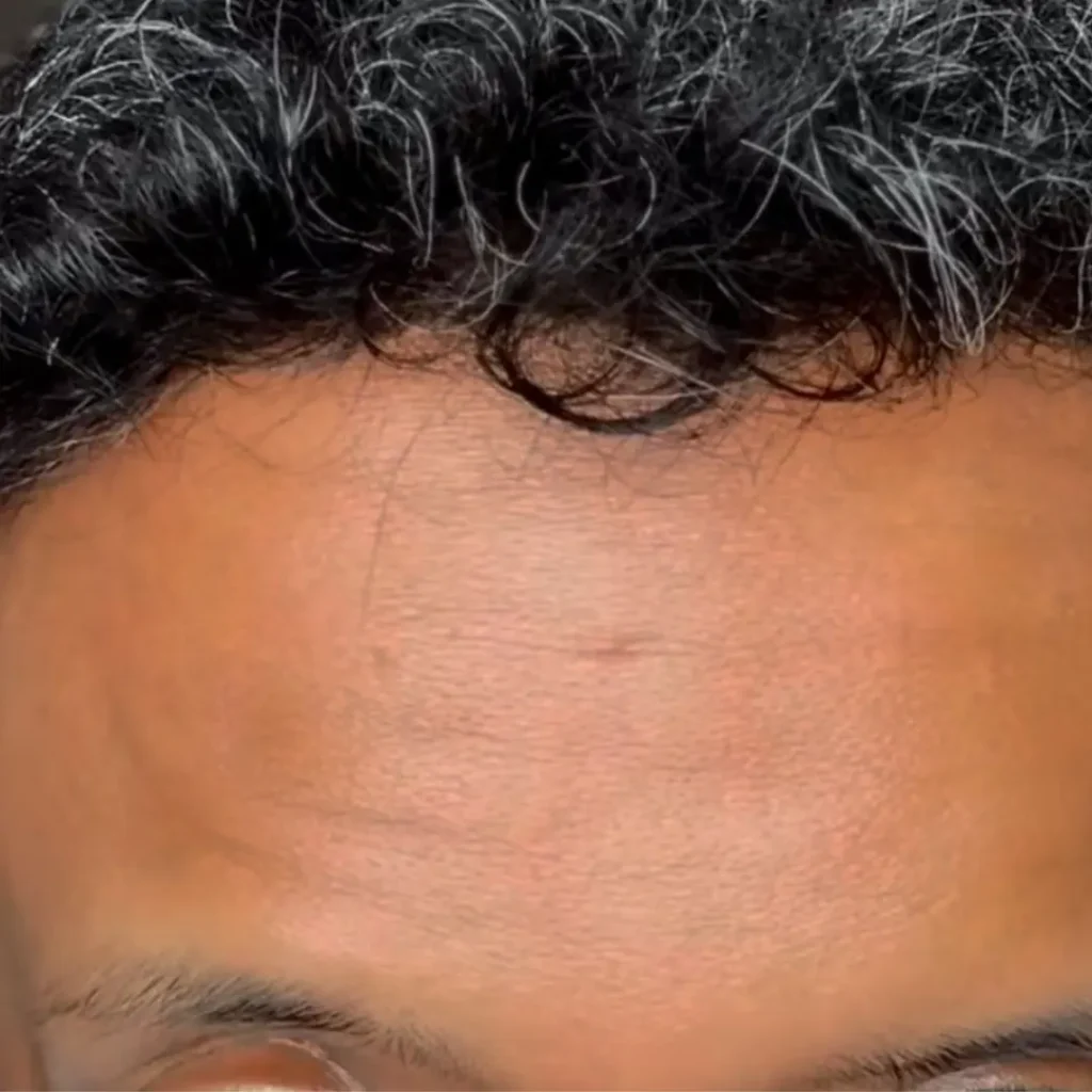 حالة 2 بوتكس في لوسيرا بعد