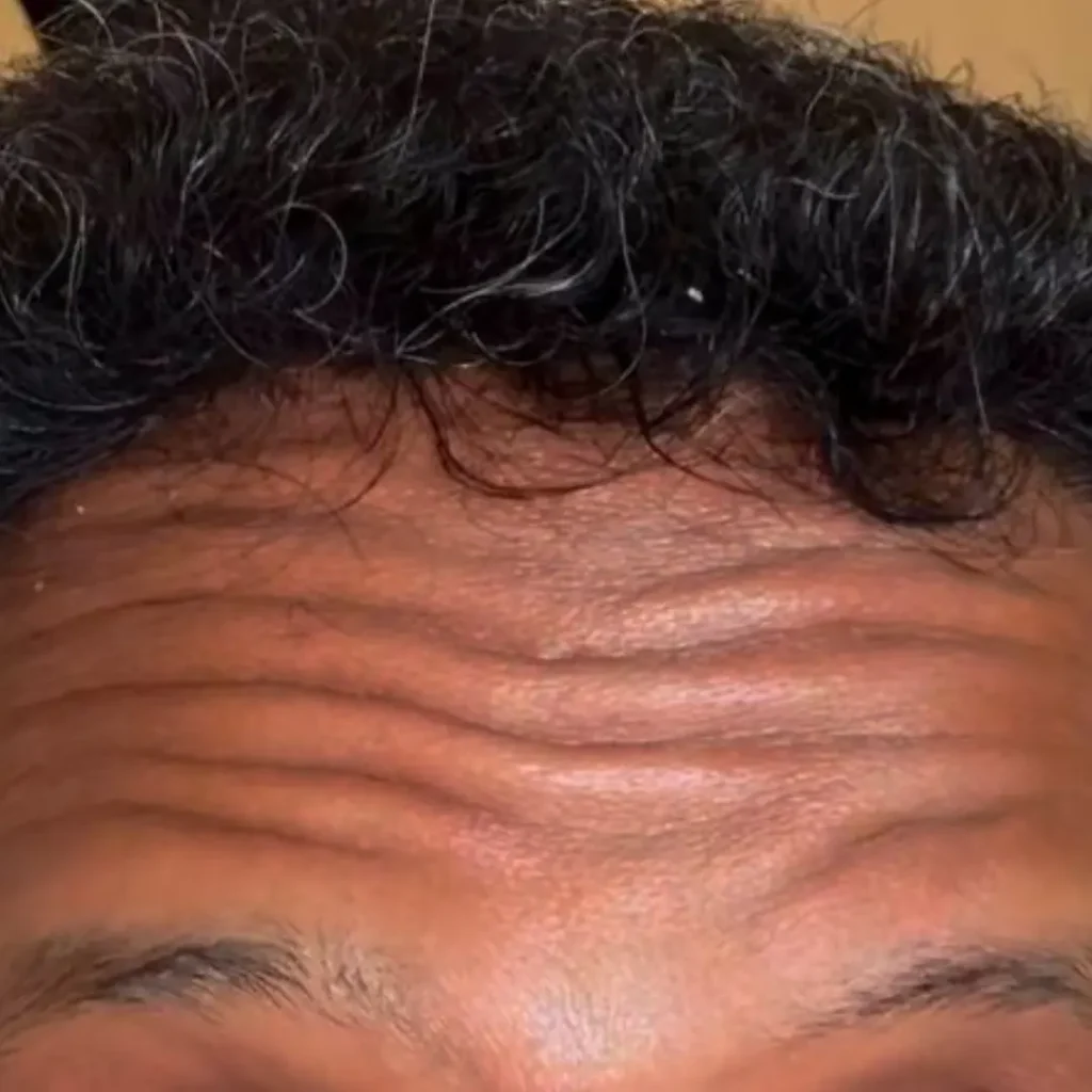 حالة 2 بوتكس في لوسيرا قبل