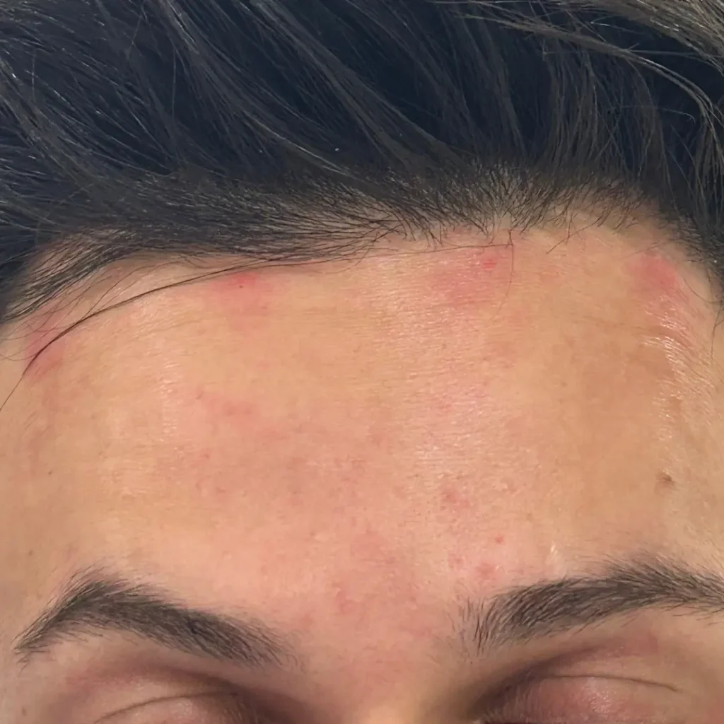 حالة 3 بوتكس في لوسيرا بعد