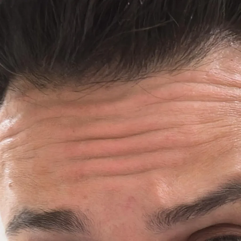 حالة 3 بوتكس في لوسيرا قبل