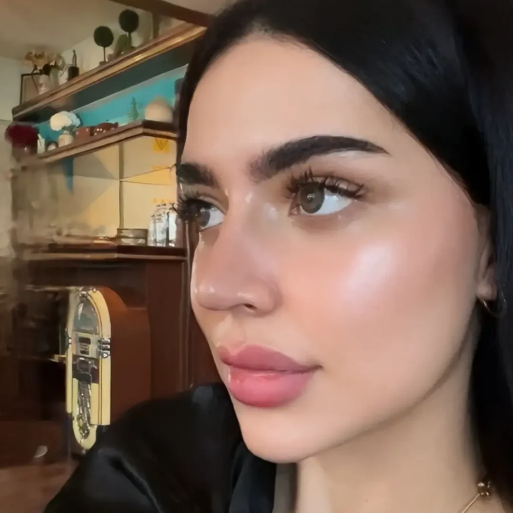 حالة 4 بوتكس في لوسيرا بعد