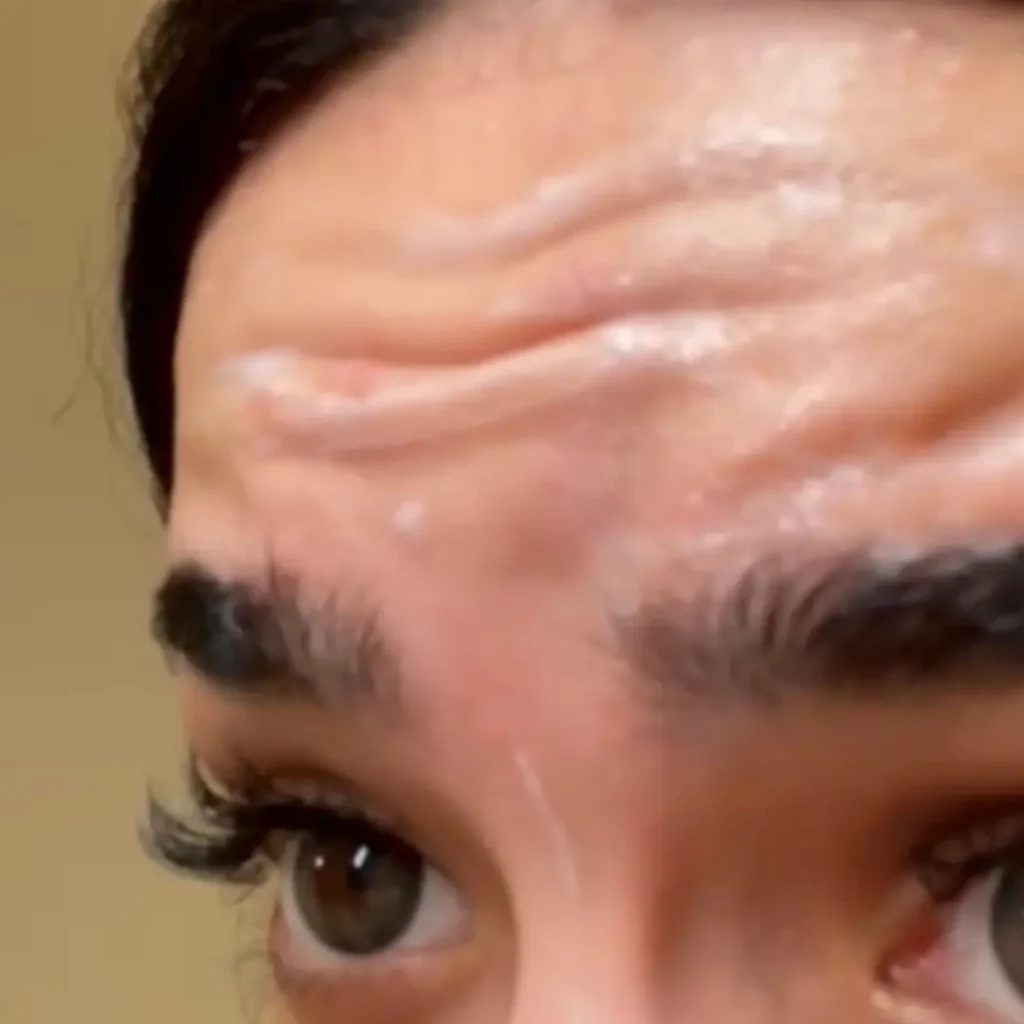 حالة 4 بوتكس في لوسيرا قبل