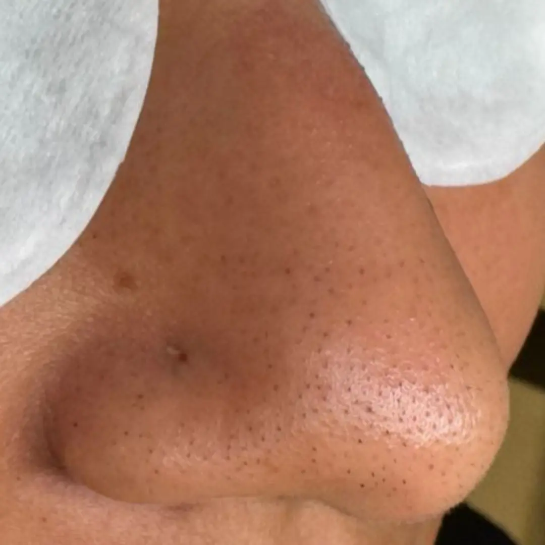 هايدرافيشيل في لوسيرا 2 قبل