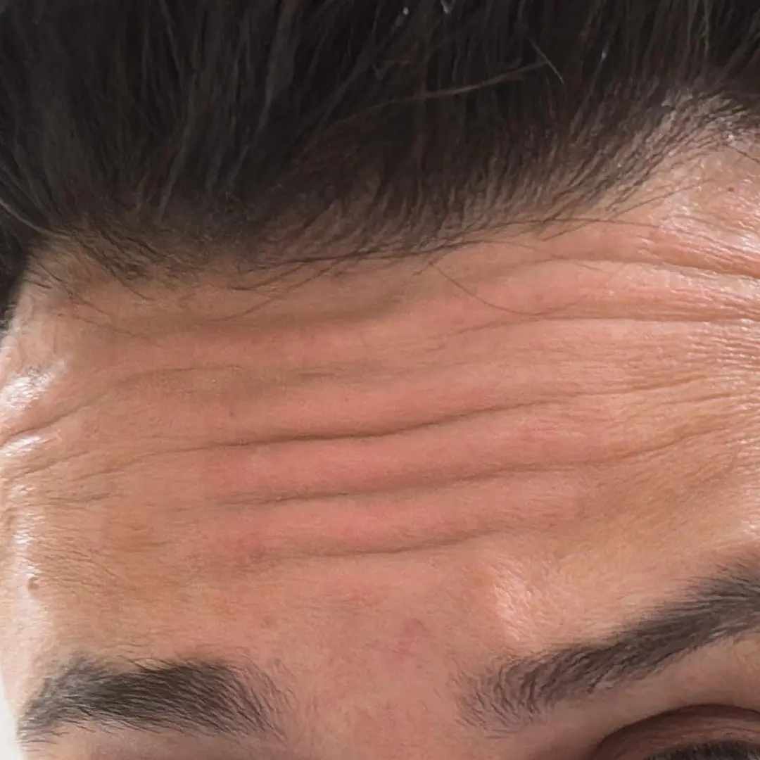 حالة-3-بوتكس-في-لوسيرا-قبل