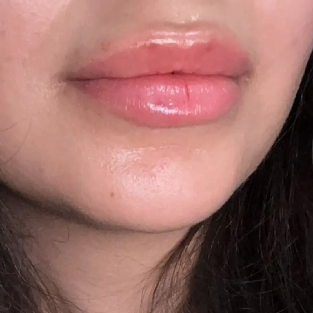 حالة-فيلر-شفايف-في-لوسيرا-بعد-5