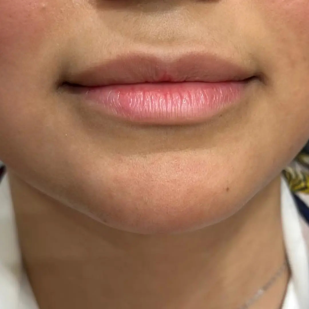 حالة-فيلر-شفايف-في-لوسيرا-قبل-5 (1)