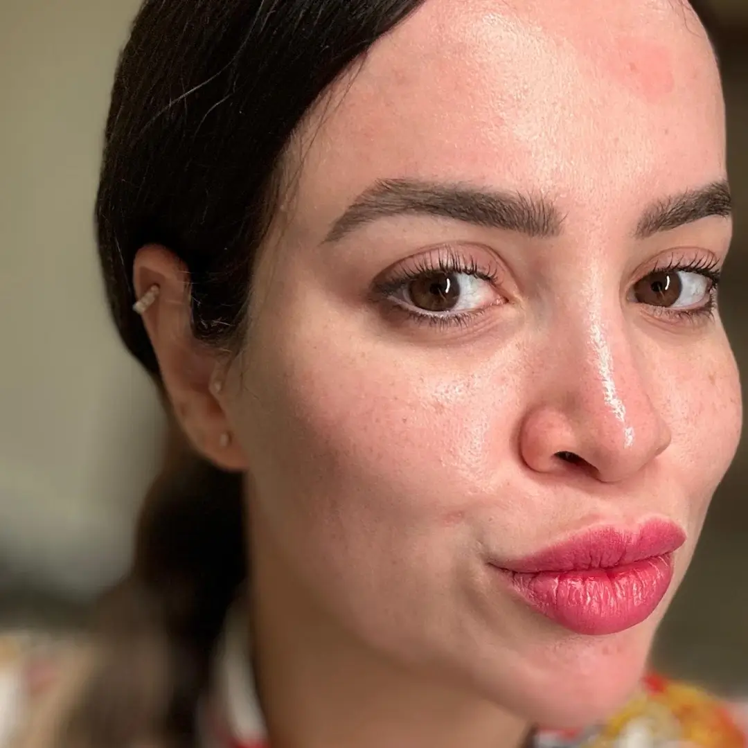 حالة-فيلر-شفايف-في-لوسيرا-قبل-8